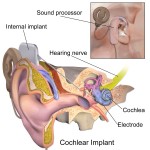 blausen_0244_cochlearimplant_01